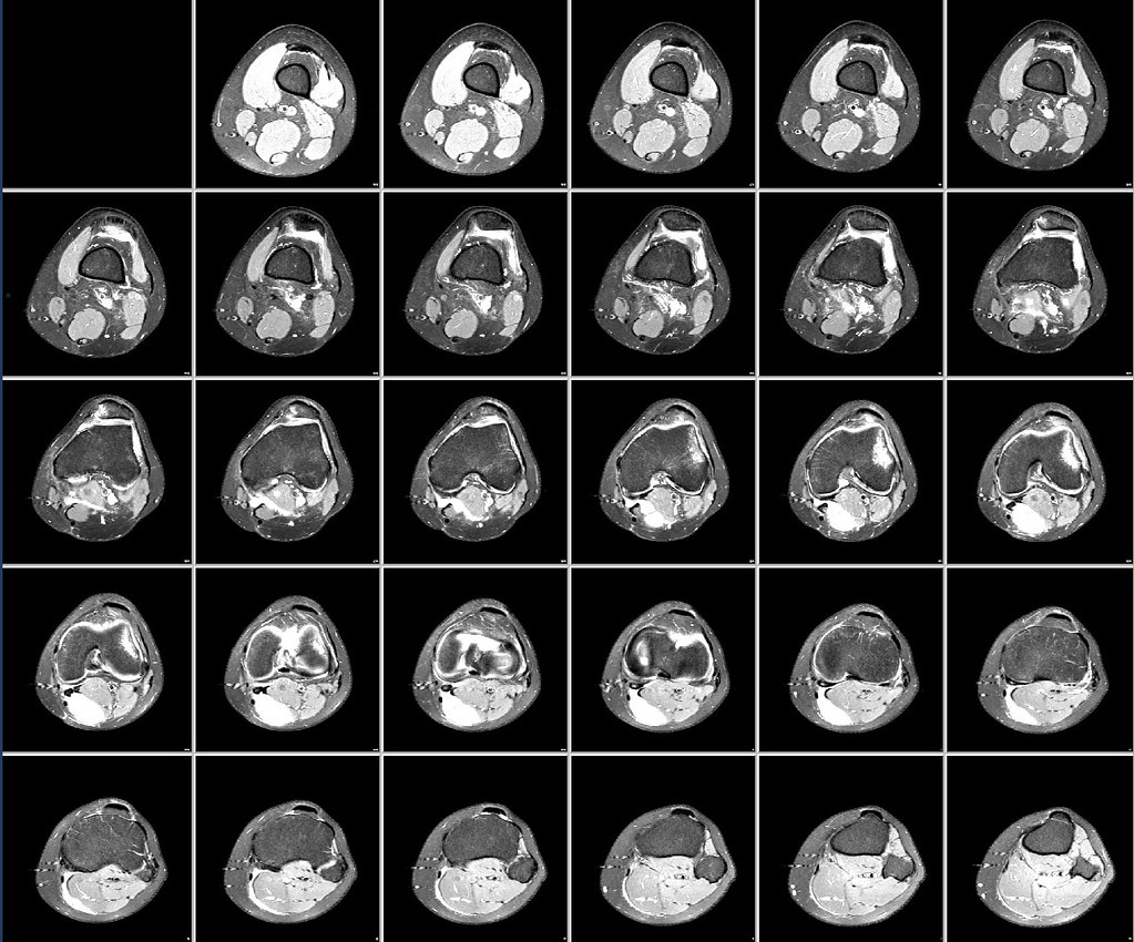 IRM du genou en imagerie osteo-articulaire